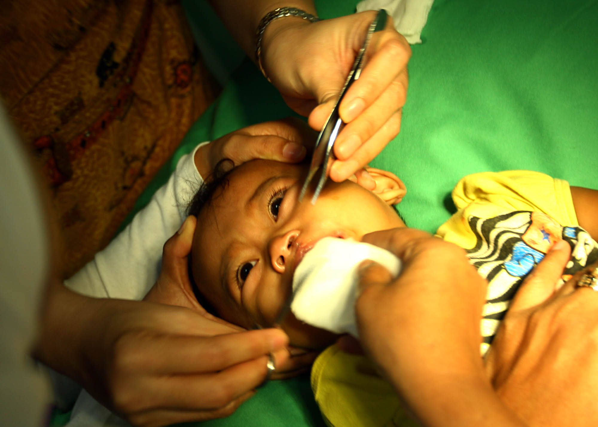 Media Group Gelar Operasi Bibir Sumbing Gratis di Tangerang