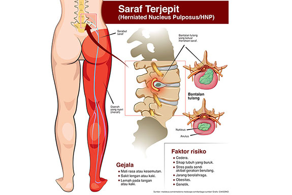 Bedah Sayatan Kecil Atasi Saraf Terjepit