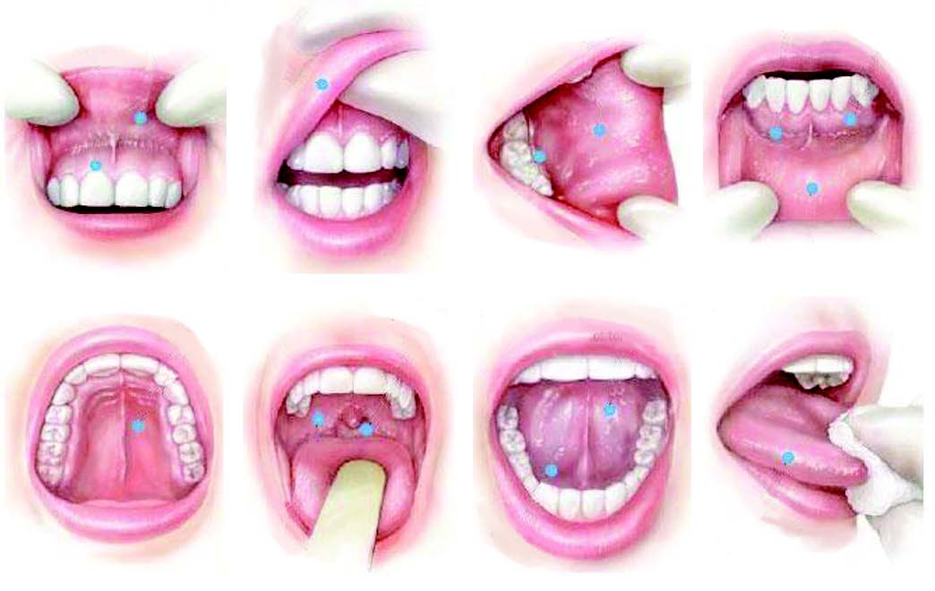 Sariawan yang Berujung Kanker