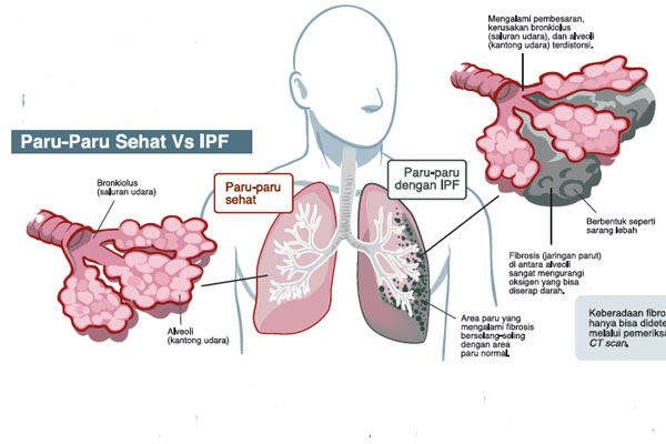 IPF, Penyakit Langka Perusak Paru