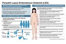 Kenali Gejala, Cegah Keparahan Lupus