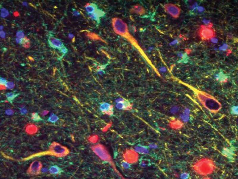 Penyebab Alzheimer Bisa Muncul dari Dalam MulutPenyebab Alzheimer