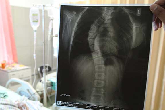 Penyakit Hemofilia merupakan penyakit yang dialami seseorang karena darah sulit membeku, sementara skoliosis (tulang belakang bengkok) 