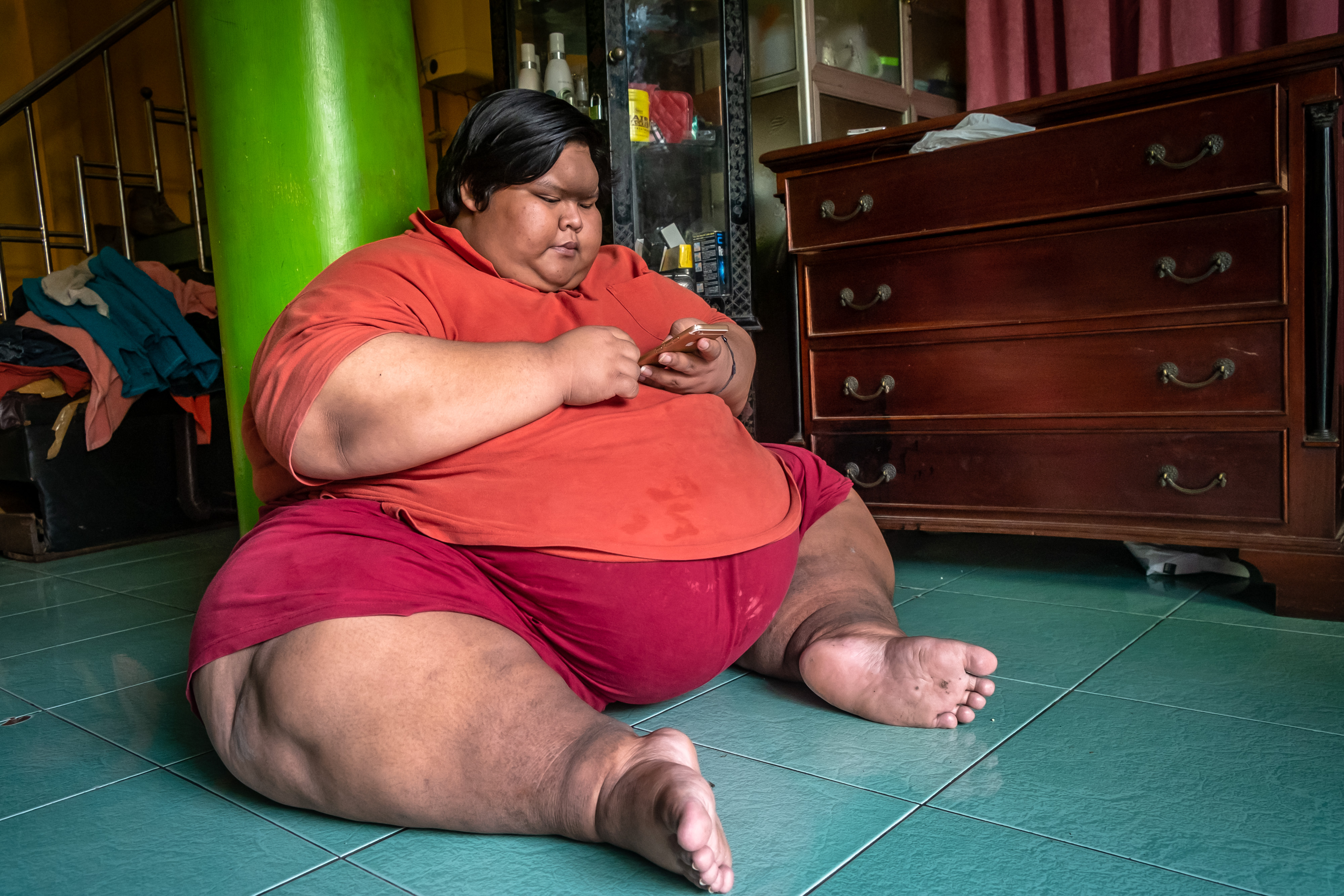 Penderita obesitas berbobot sekitar 250 kilogram, Bimo Putro Prakoso (22)