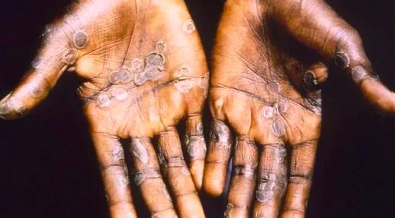 Pasien yang terkena virus cacar monyet.