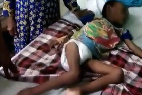 Hidayat,7, bocah Karawang yang terkena gizi buruk 