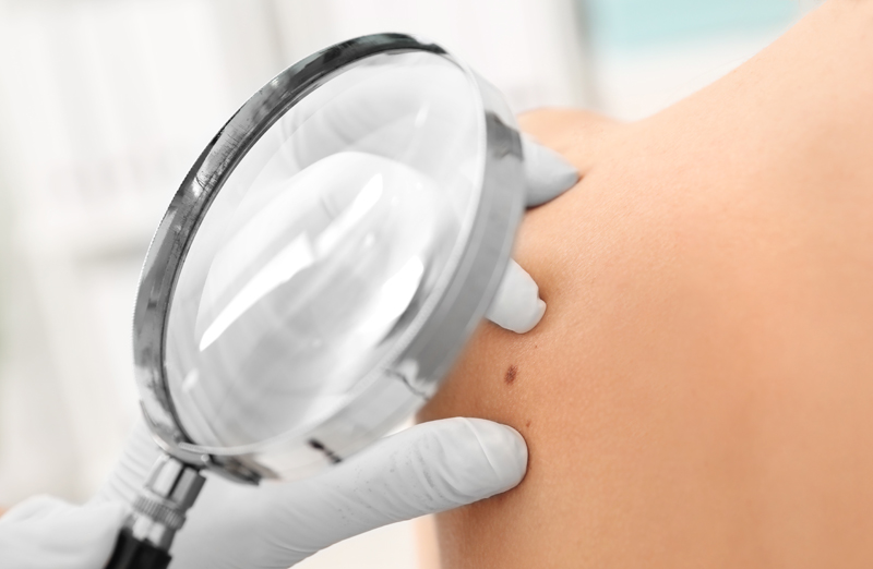 Para peneliti menemukan mereka yang memiliki kerabat dekat yang terkena kanker kulit, berpotensi memiliki penyakit yang sama.