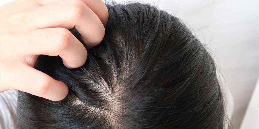 Ketombe Iritasi Kulit Kepala, Bikin Rambut Rontok