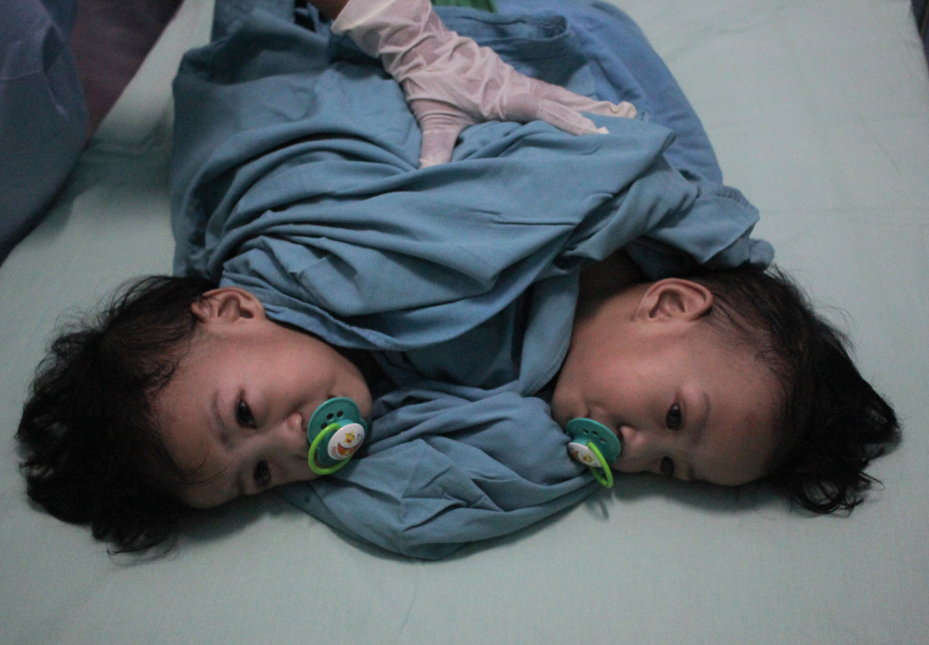 Bayi kembar siam Aqila dan Azila