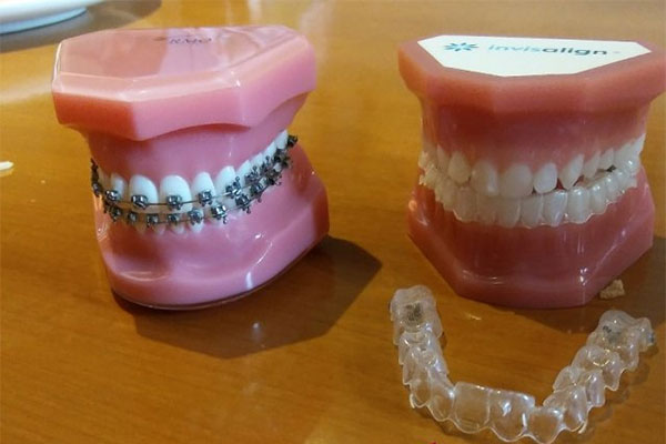 Ilustrasi gigi menggunakan kawat gigi tradisional (kiri) dan clear aligner Invisalign.  