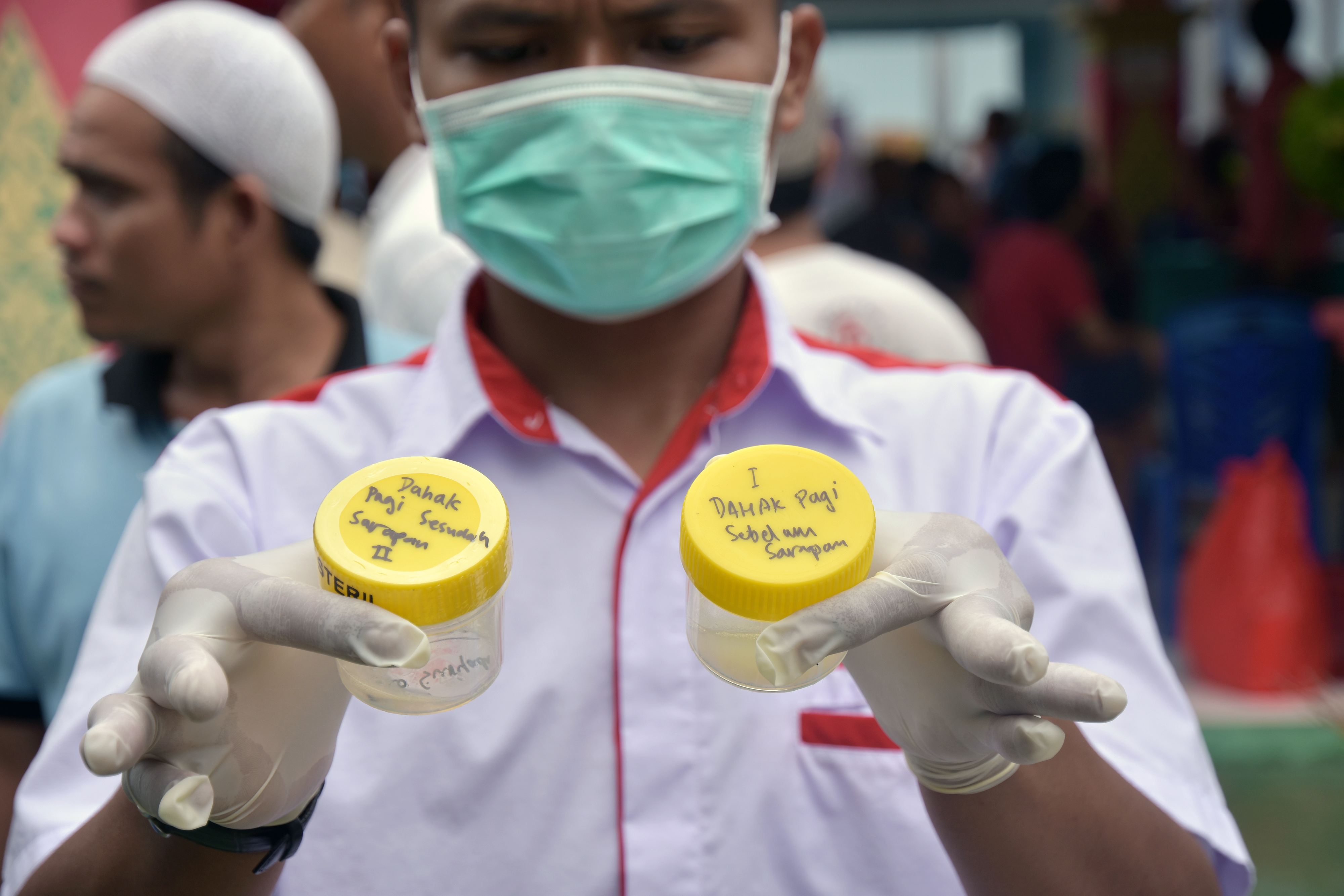 Petugas menunjukkan sampe dahak pasien yang akan diteliti di lab. Pemkab Cianjur menargetkan penurunan jumlah kasus TBC pada 2030.