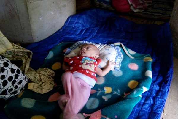 Balita yang mengalami gizi buruk.