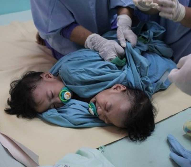 Ilustrasi Pemisahan Bayi Kembar Siam.