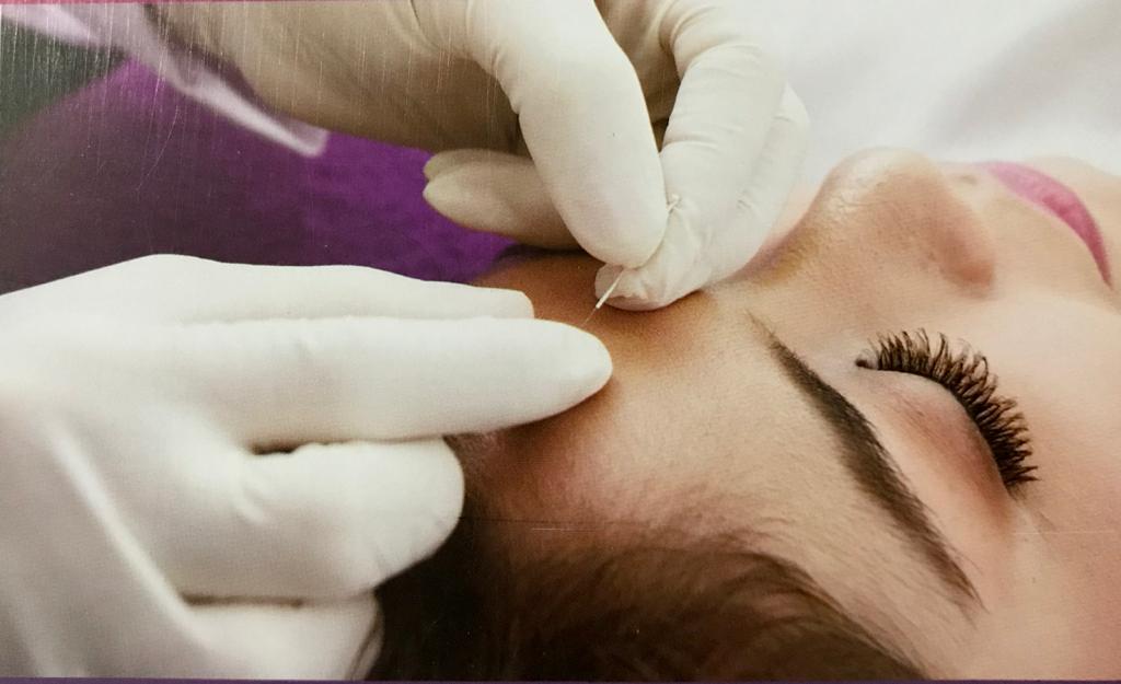 Akupunktur untuk mengatasi obesitas merupakan teknik terapi dengan perangsangan titik-titik tertentu di permukaan tubuh.