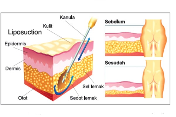 Liposuction yang aman harus dilakukan sesuai kondisi masing-masing pasien.