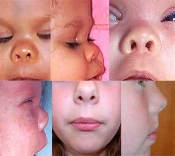 Salah satu ciri Bohring-Opitz adalah Anteverted nares, yakni ujung hidung menghadap ke atas membuat lubang hidung lebih terlihat jelas.