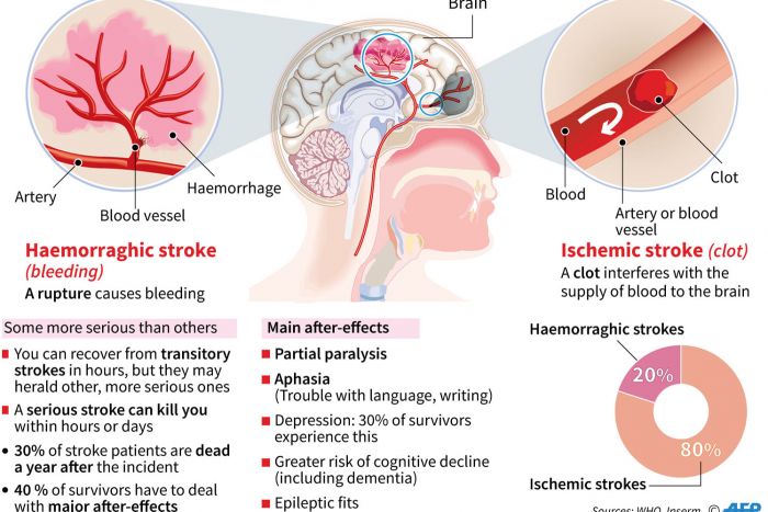 Ilmuwan Temukan Cara Perbaiki Sel Otak yang Rusak Akibat Stroke