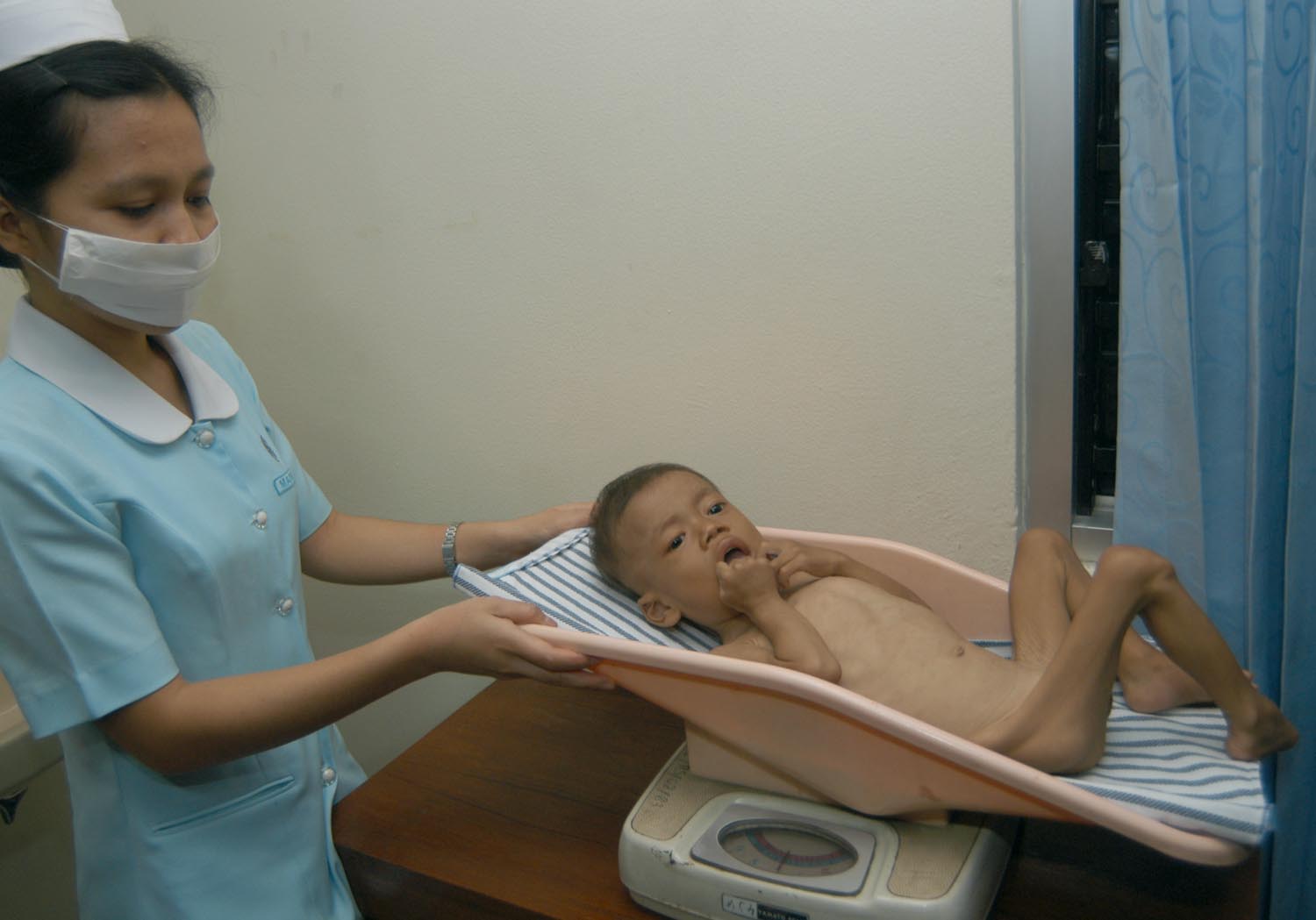 Seorang anak penderita malnutrisi dirawat di RS PGI Cikini Jakarta