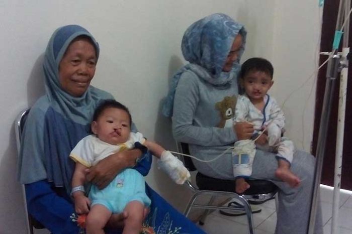 Ilustrasi Balita dengan Bibir Sumbing.