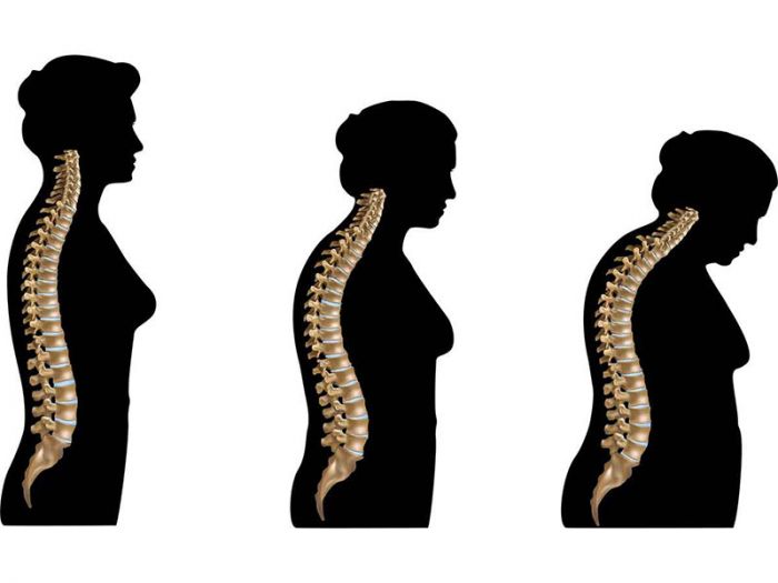 satu dari tiga wanita usia di atas 50 tahun mengalami patah tulang akibat osteoporosis.