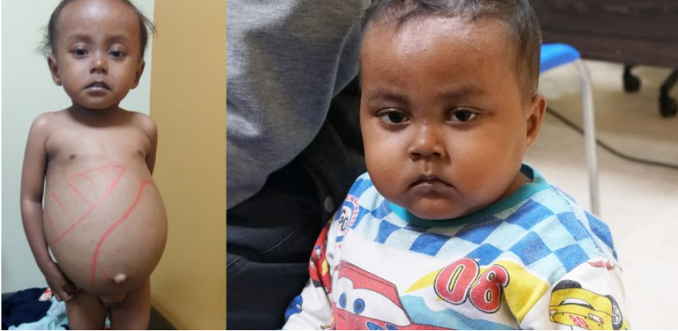 Penyakit Langka Gaucher Bisa Diobati dengan Terapi Sulih Enzim