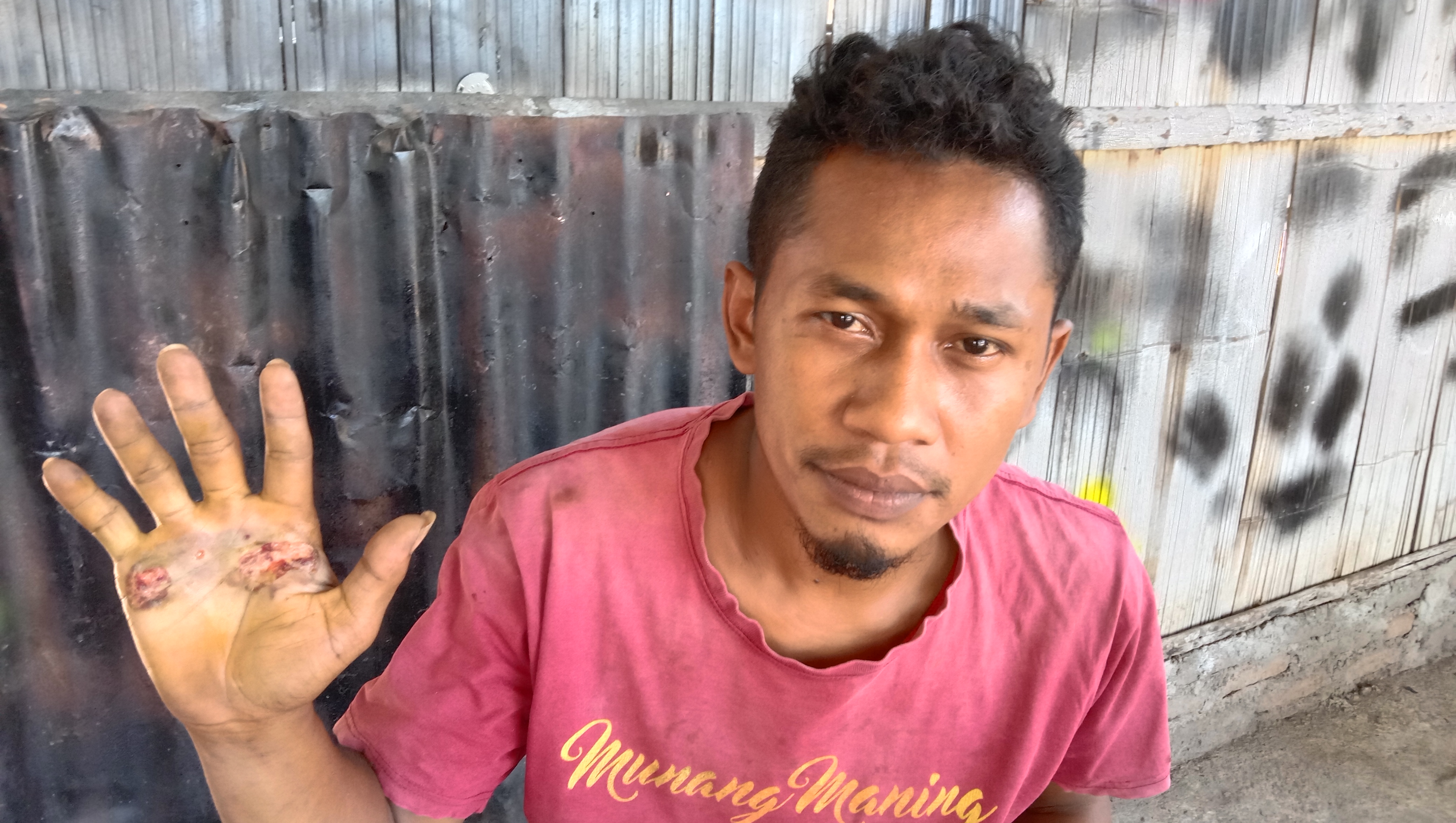  Mikael Ariyanto menunjukkan tangannya yang terluka akibat dihukum dengan besi panas