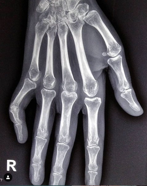 Ilustrasi radang sendi.