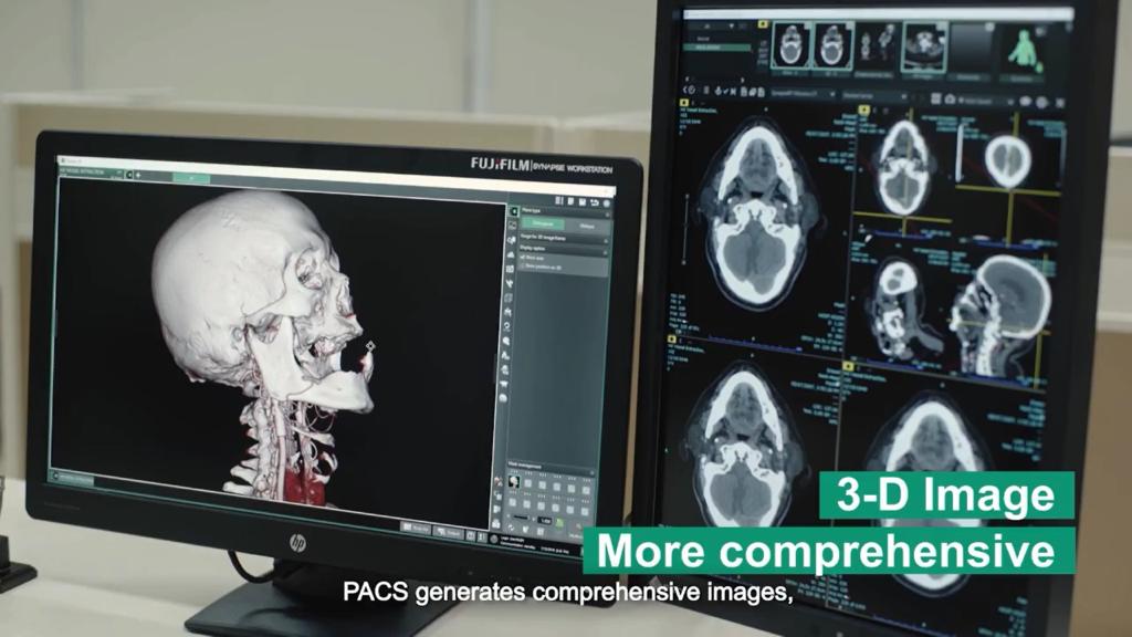 PACS (Picture Archiving & Communication System) Synapse merupakan teknologi kecerdasan buatan dalam bidang radiologi.
