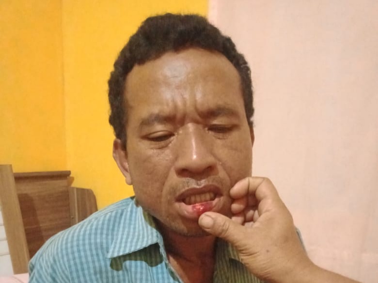 Yosef Sudirman Bagu, korban penganiayaan oleh tentara dan polisi di Manggarai Barat.