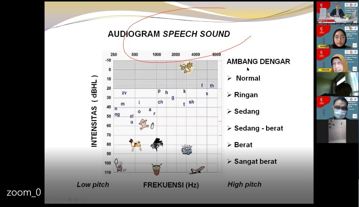 Waspadai Gangguan Pendengaran Pada Anak, Ini Penjelasan Dokter THT