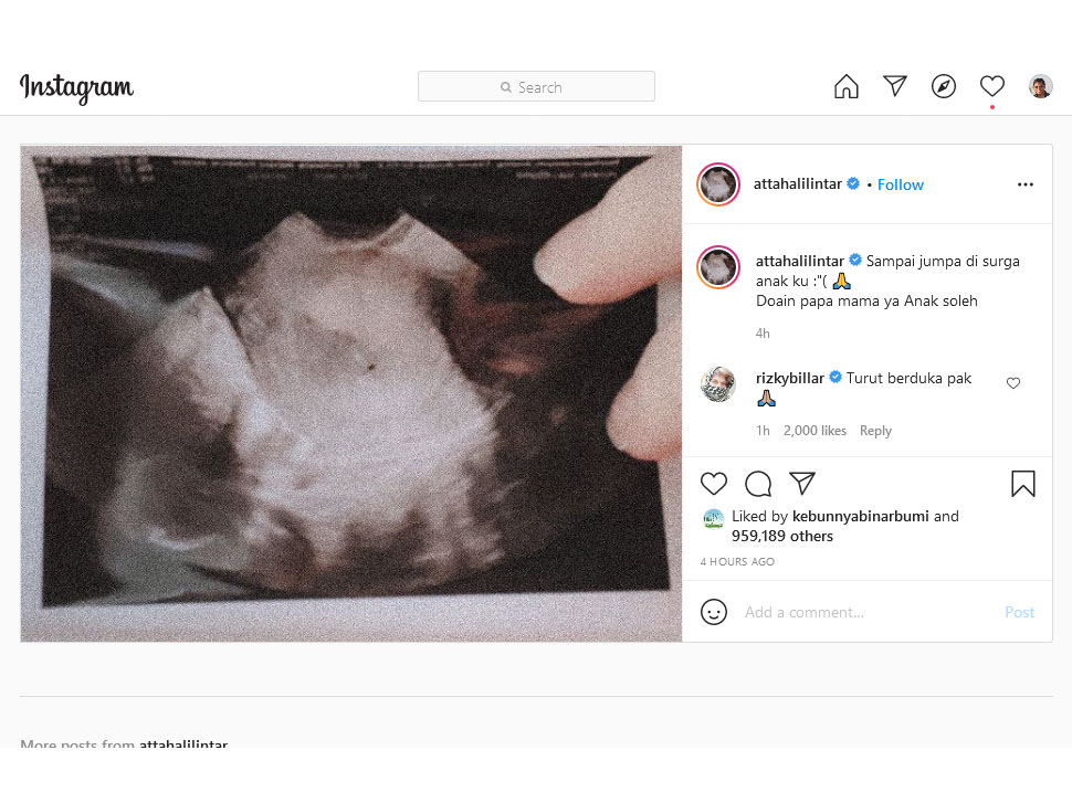 Aurel Hermansyah keguguran