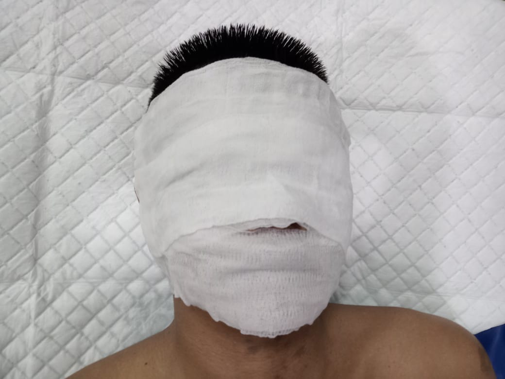 Pimpinan Redaksi www.jelajahperkara.com, Persada Bhayangkara Sembiring jalani perawatan setelah wajahnya disiram air keras orang tak dikenal