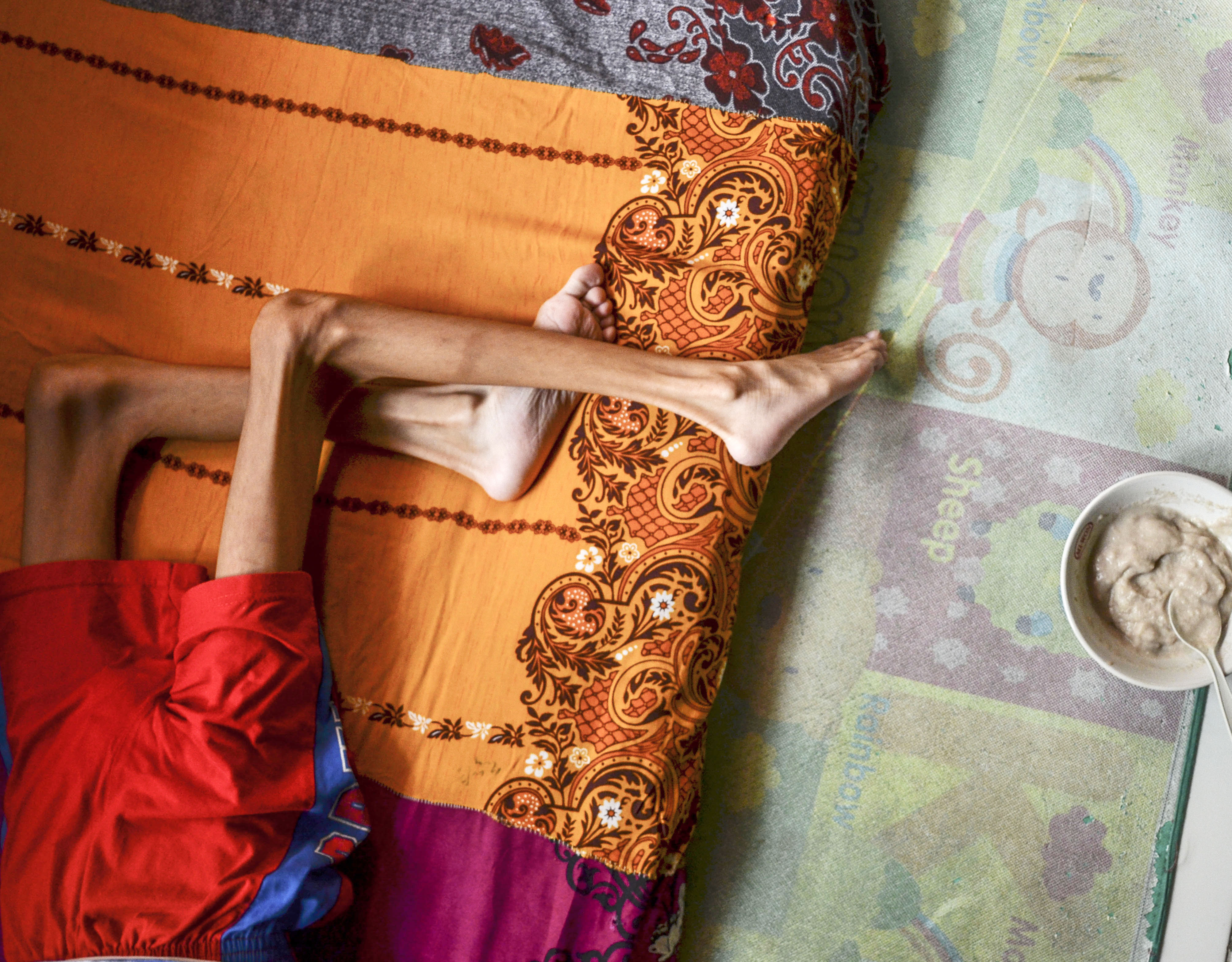 Iqbal Maulana, penderita gizi buruk di Desa Peledah, Kecamatan Padaherang, Kabupaten Pangandaran Jabar, Jumat (18/6/2021)