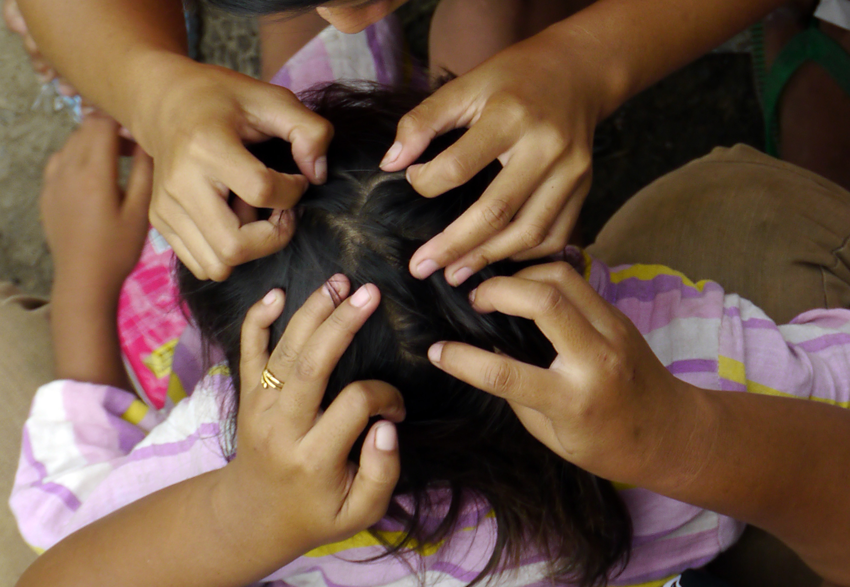 Seorang anak yang terkena kutu rambut