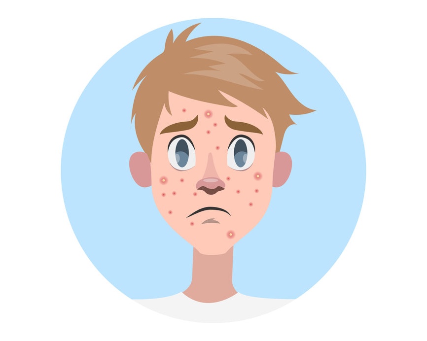 Ada banyak mitos cara menghilangkan jerawat yang ternyata tidak dianjurkan dokter kulit. 