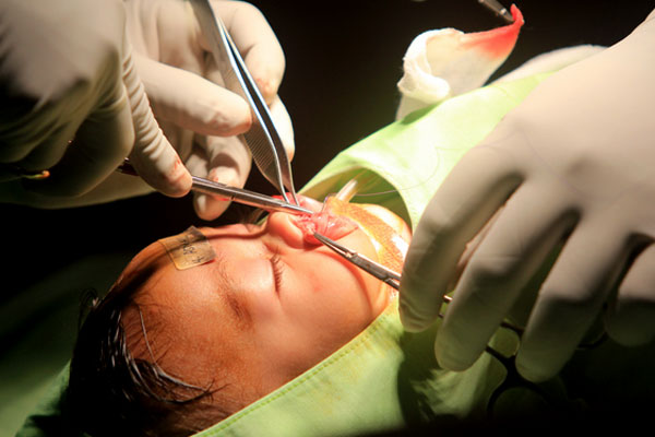 Operasi bibir sumbing.