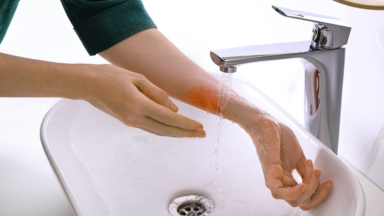 Jangan Hiraukan Luka Kecil, Ini Cara Penanganan Mandiri di Rumah 