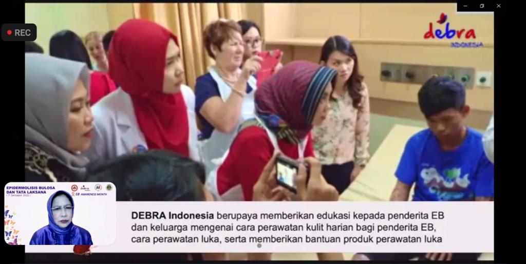 Webinar yang diselenggaraan bersamaan dengan Epidermolysis Bulosa Awareness Month 2021.
