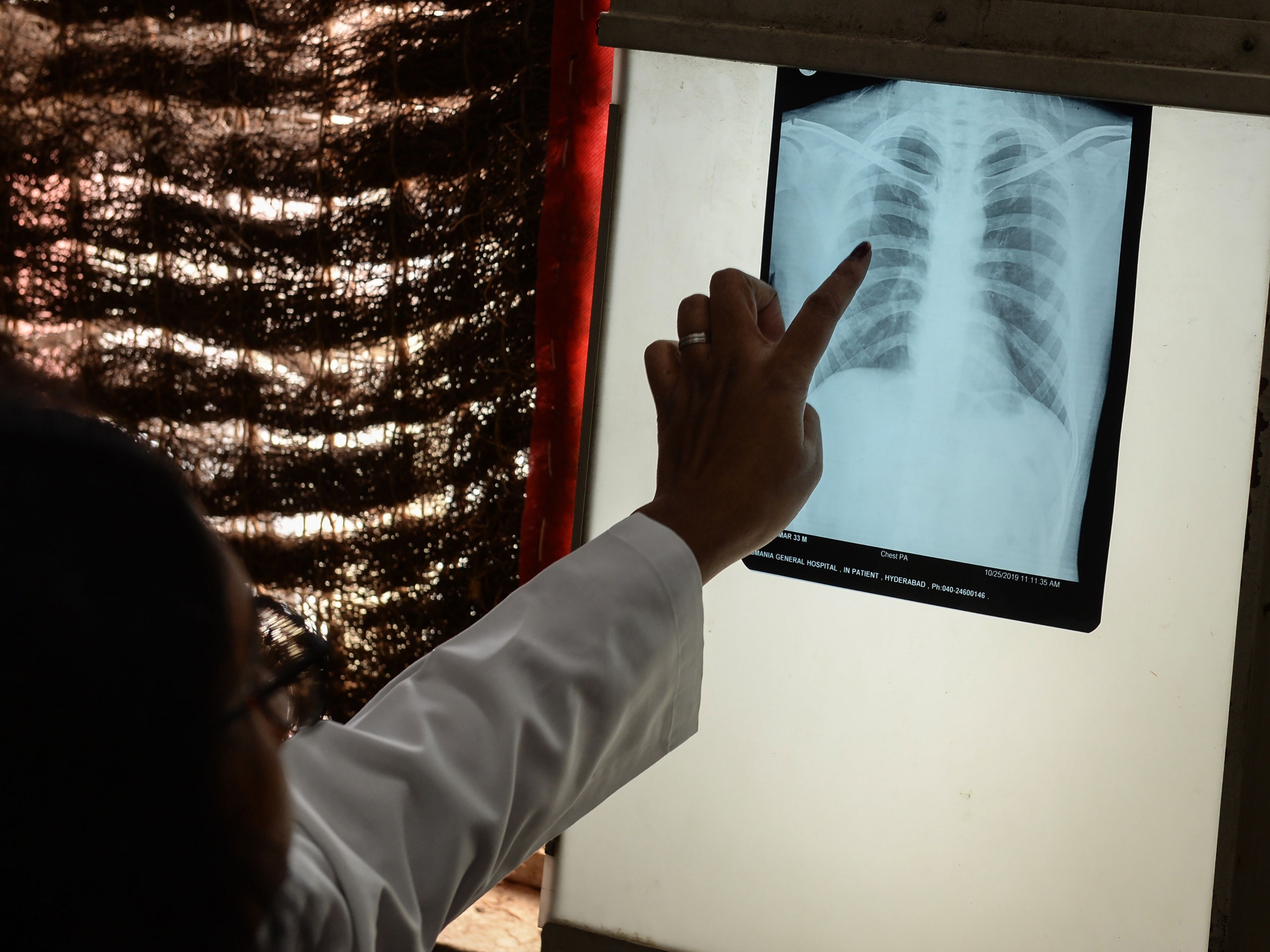 Penelitian Terbaru: Bernapas saja Dapat Sebarkan Bakteri TBC