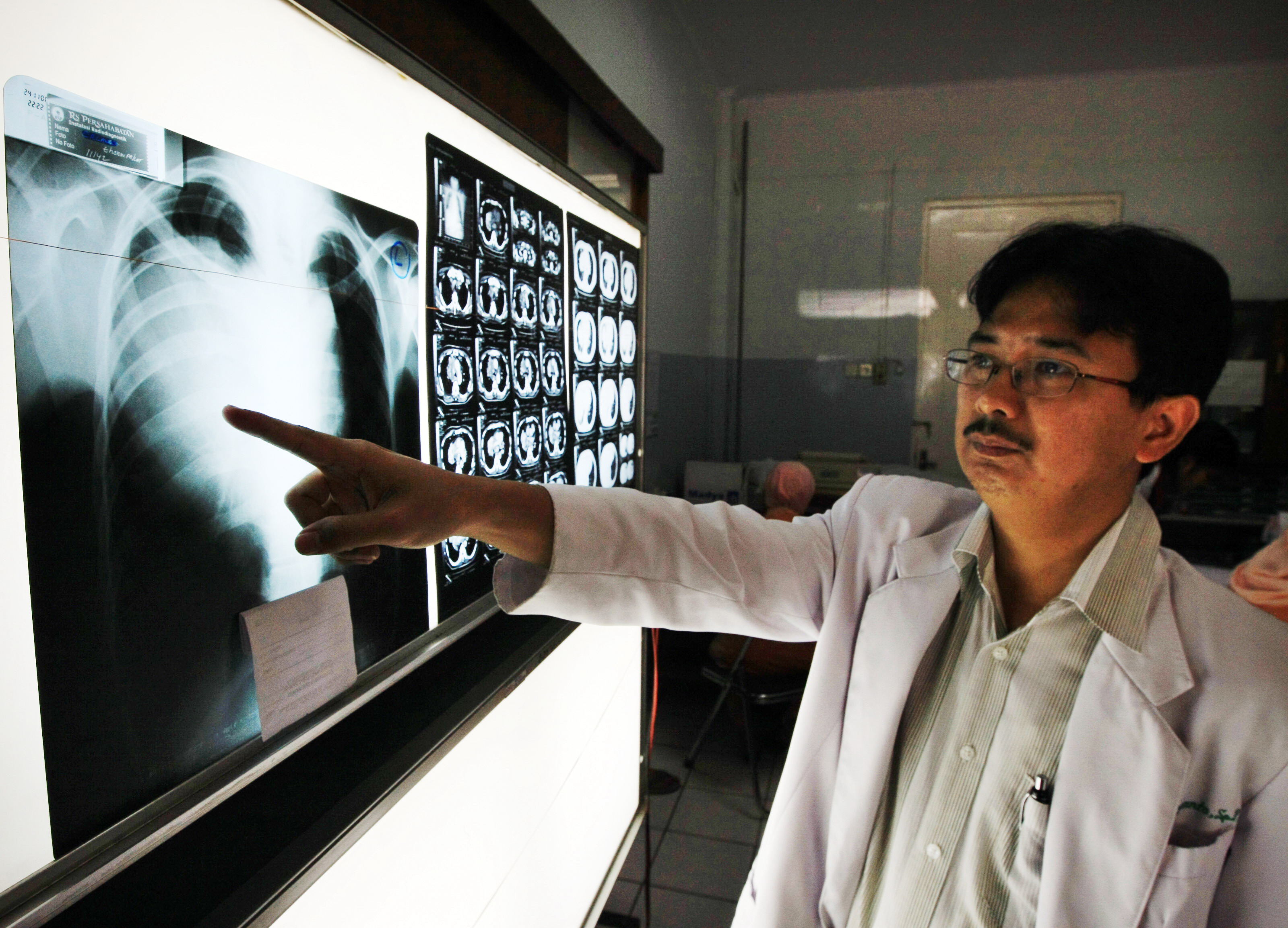 Ahli paru-paru Dr. Agus Dwi Susanto (kanan) menunjukkan hasil rontgen pasien yang terkena kanker paru-paru di RS.Persahabatan, Jakarta Timur