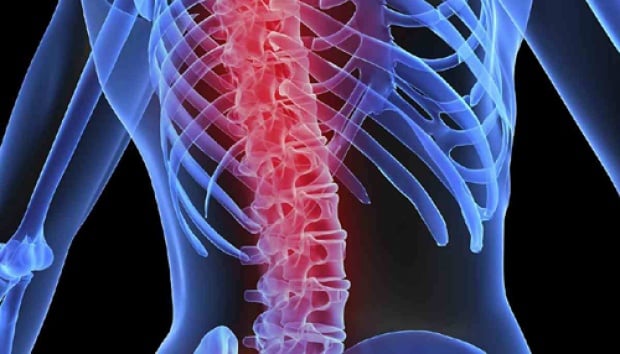 Yuk Mengenal Cedera Saraf Tulang Belakang, Penyebab Meninggalnya Laura Anna