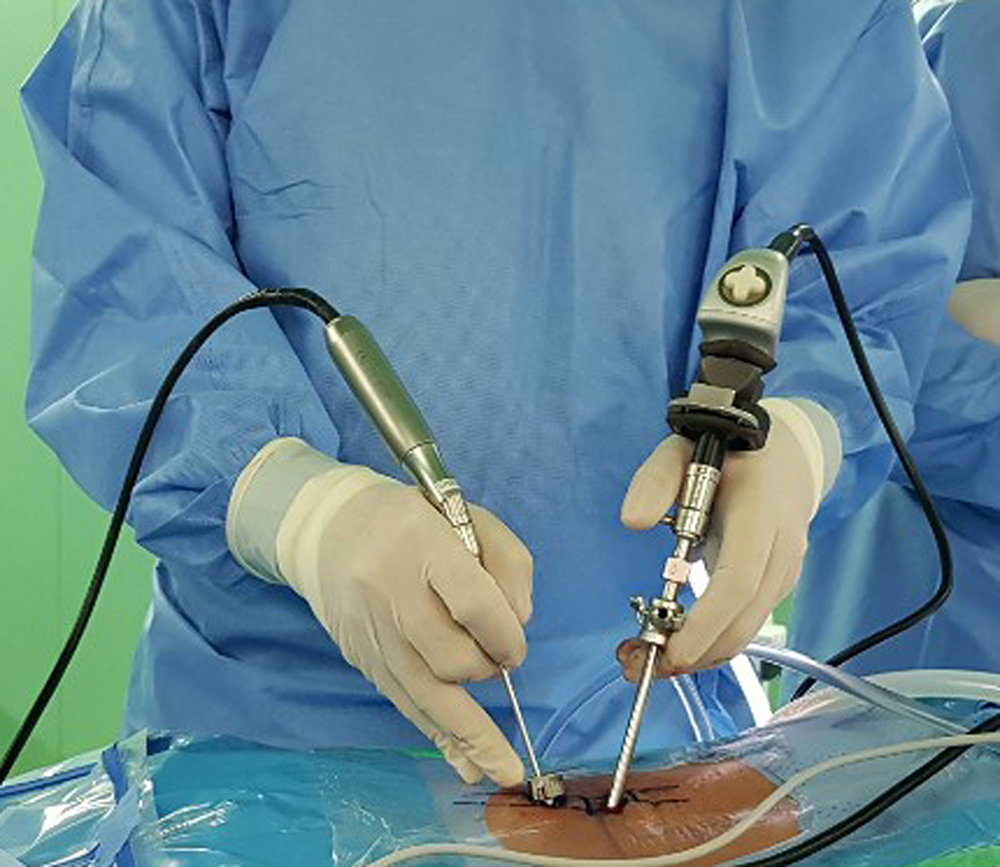 Endoskopi tulang belakang sudah lahir generasi ketiga atau yang terbaru yakni Biportal Endoscopic Spine Surgery atau BESS. 