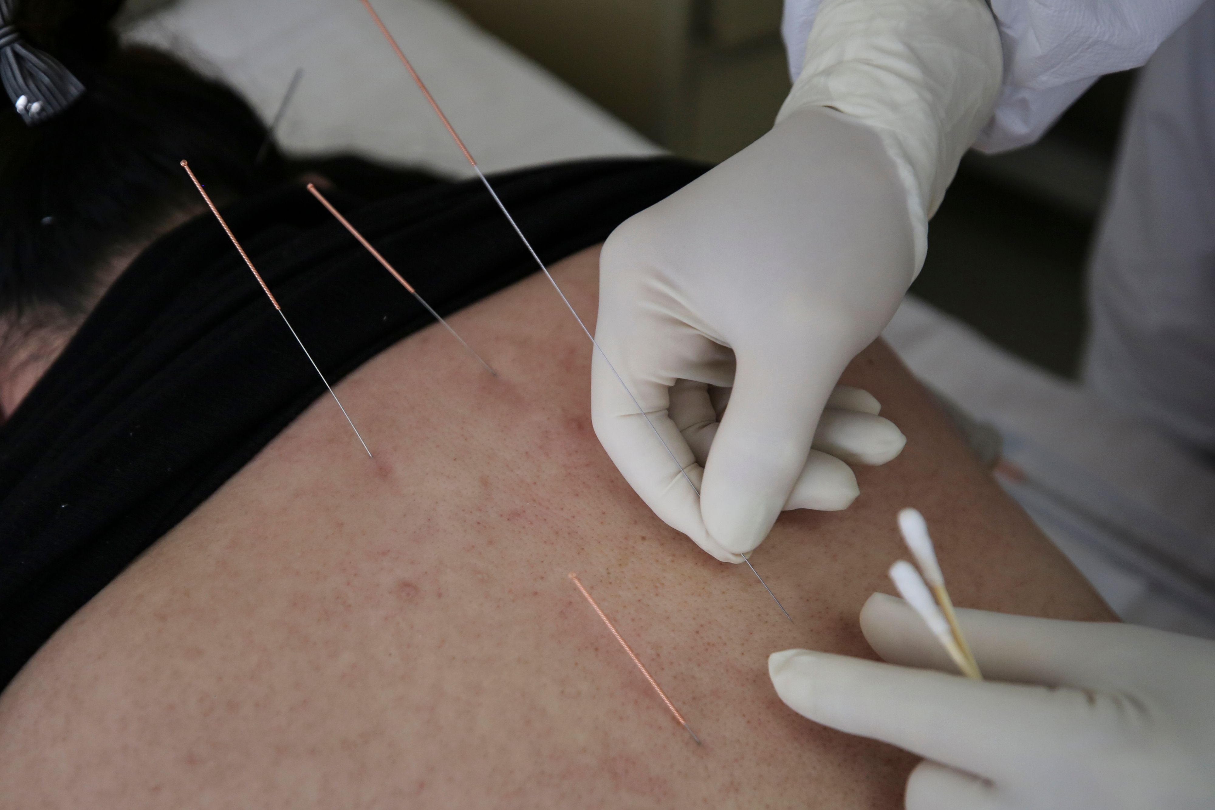 Akupuntur untuk kecantikan dapat dilakukan sedini mungkin.