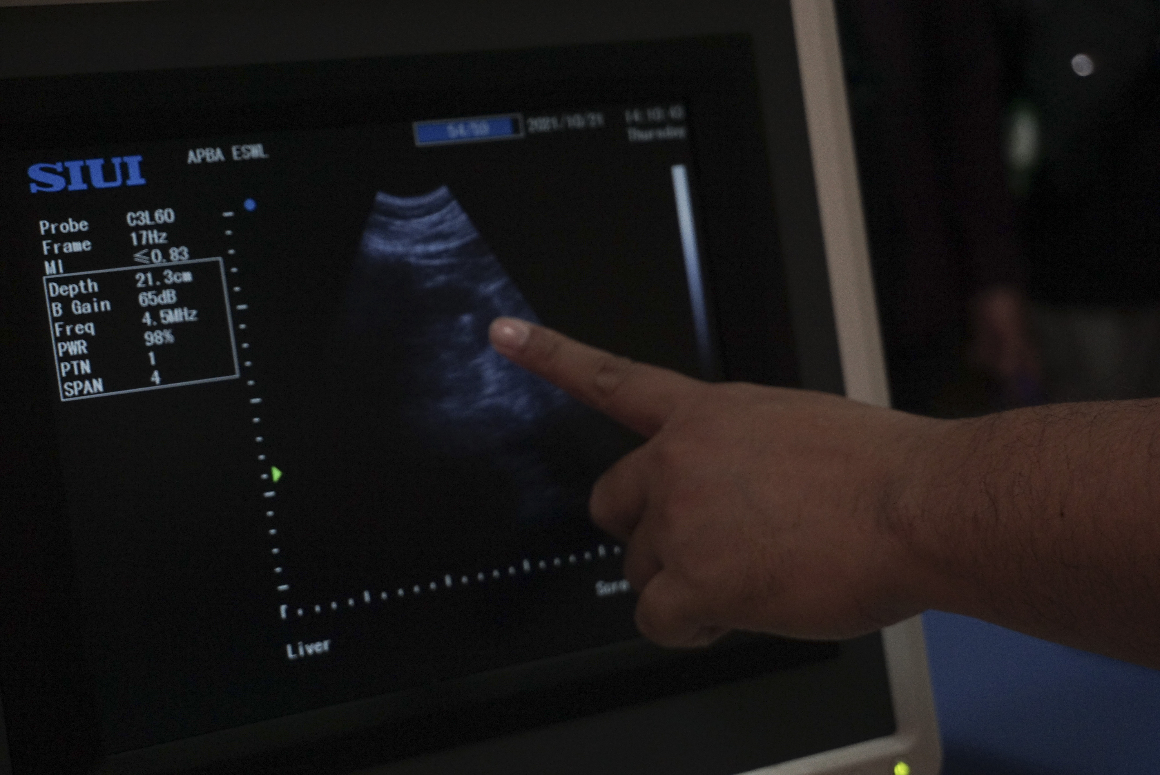 Alat pemecah batu ginjal tanpa operasi atau Extracorporeal Shock Wave Lithotripsy (ESWL) di RS QIM, Kabupaten Batang. 