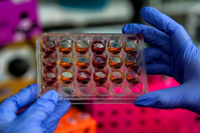 Stem cell menjadi alternatif yang meningkatkan harapan hidup pasien kanker multiple myeloma.