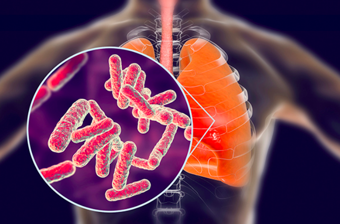 Kolaborasi Kesehatan Hingga Politik Perlu Dilakukan Penanganan TB