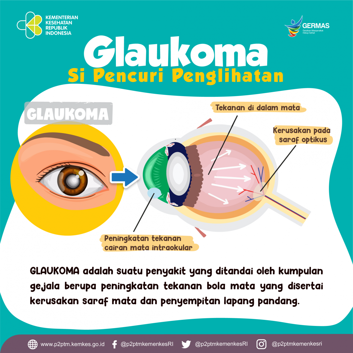 Glaukoma merupakan 1 dari 5 penyebab kebutaan tertinggi di dunia.