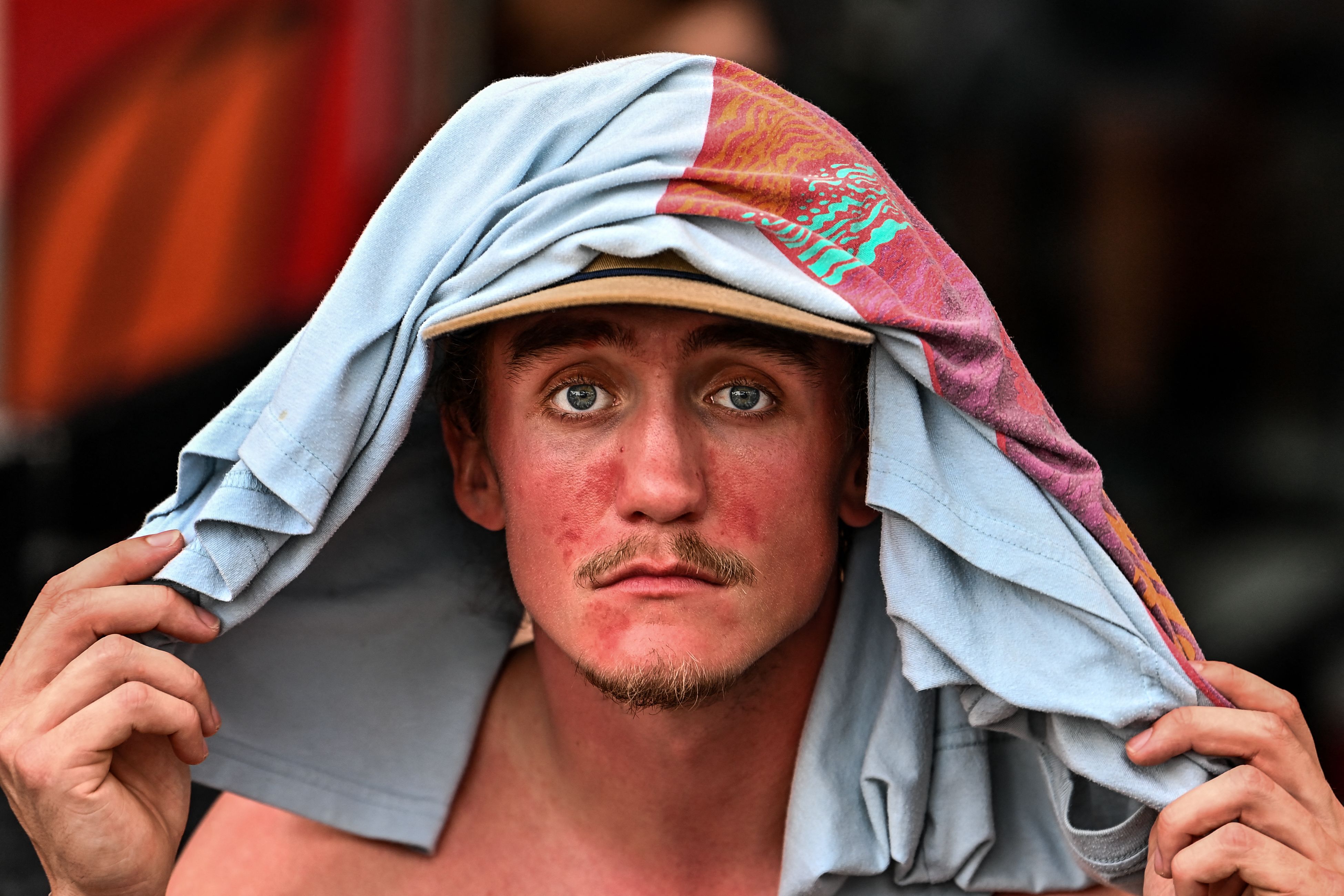 Seorang pria di pantai Florida, AS, mengalami luka bakar akibat sengatan matahari di bagian wajah.