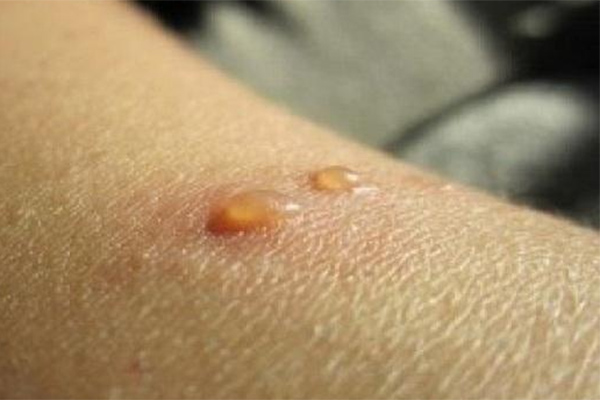 Kanada Konfirmasi Dua Kasus Pertama Cacar Monyet