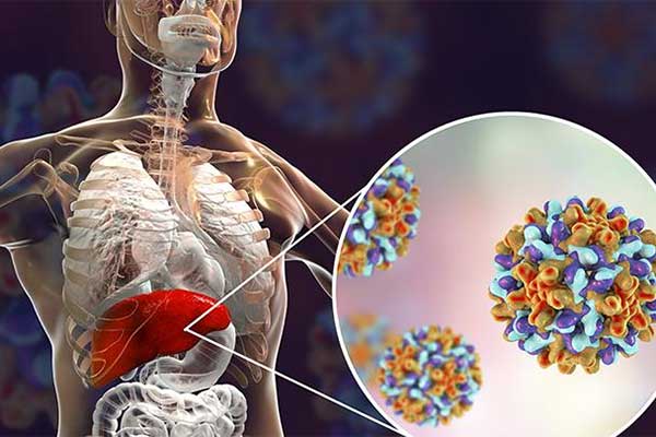 Hepatitis 